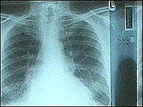 Asbestosis Scarring X-Ray